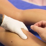 Dry needling